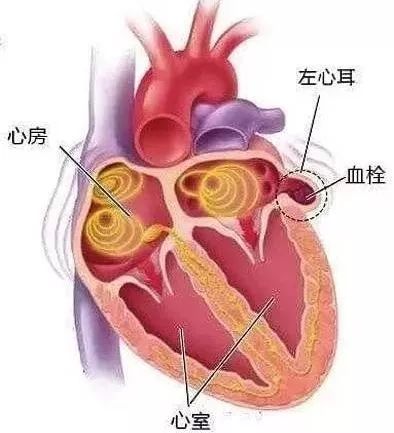 人到中年，如何避免腦梗死，做到三個堅決，讓你生活更健康
