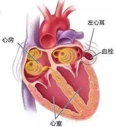 人到中年，如何避免腦梗死，做到三個(gè)堅(jiān)決，讓你生活更健康