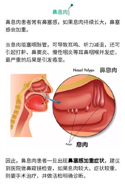 “息肉”離癌癥有多遠(yuǎn)？腫瘤專家：這樣的最危險(xiǎn)