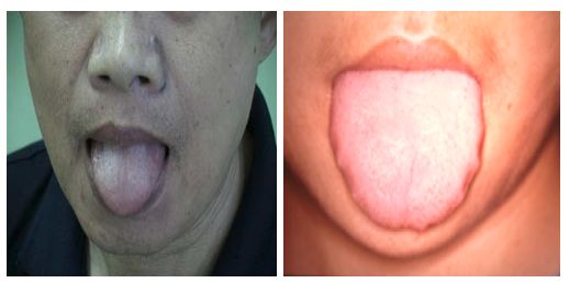 最容易被忽視的腫瘤征兆！如何提早發(fā)現(xiàn)？內(nèi)附權威自測表