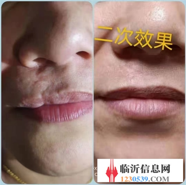修復(fù)斑疤痘敏，各種問(wèn)題性皮膚