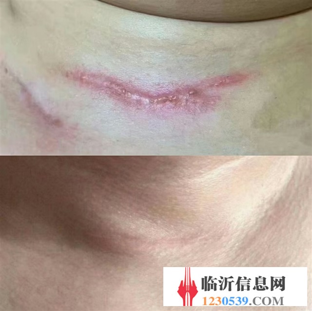 修復(fù)斑疤痘敏，各種問(wèn)題性皮膚