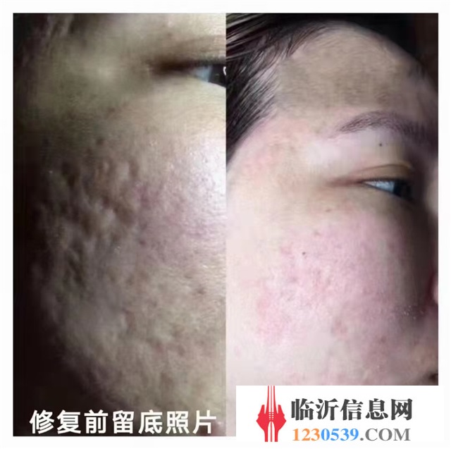 修復(fù)斑疤痘敏，各種問(wèn)題性皮膚