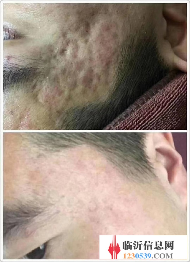 修復(fù)斑疤痘敏，各種問(wèn)題性皮膚