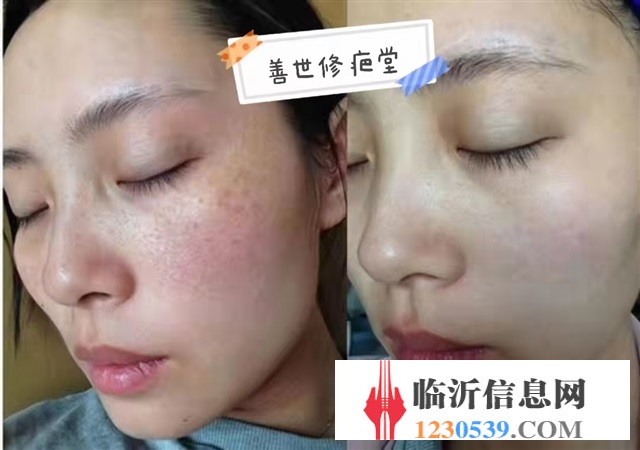 修復(fù)斑疤痘敏，各種問(wèn)題性皮膚